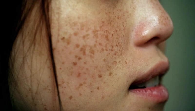 Nám chân đinh là gì? Nguyên nhân, cách trị tận gốc