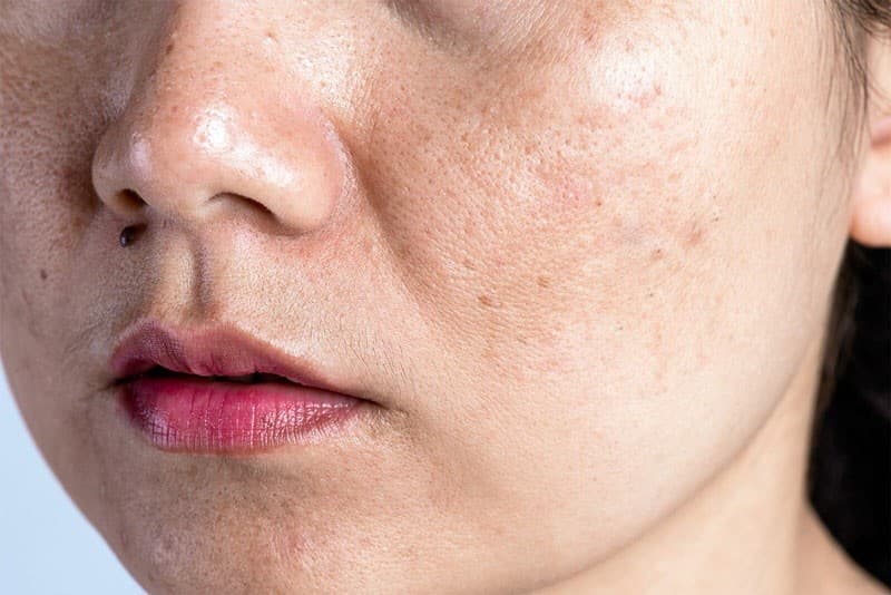 Nám mảng là gì? Hướng dẫn 4+ cách điều trị nám mảng hiệu quả